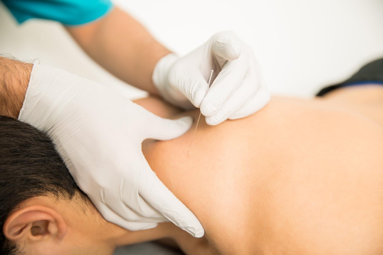 Gentle insertion of thin acupuncture needle by practitioner