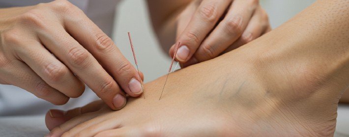 Acupuncture needle treatment for foot neuropathy