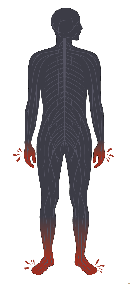Peripheral neuropathy nerve path body silhouette